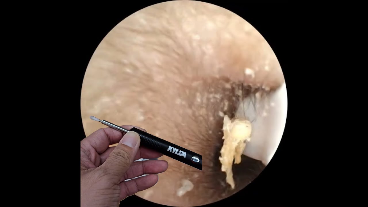 Xyla Ear Wax Removal Kit: Satisfying Deep Clean At Home