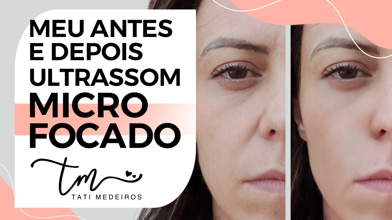 Fiz ULTRASSOM MICROFOCADO - Conto Tudo ( Preço, Doeu, Antes e Depois)