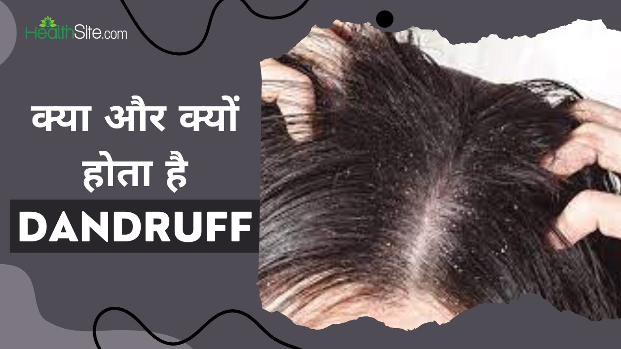 Dandruff Treatment At Home: क्यों होता है बालों में डैंड्रफ और क्या है इससे बचाव का तरीका?