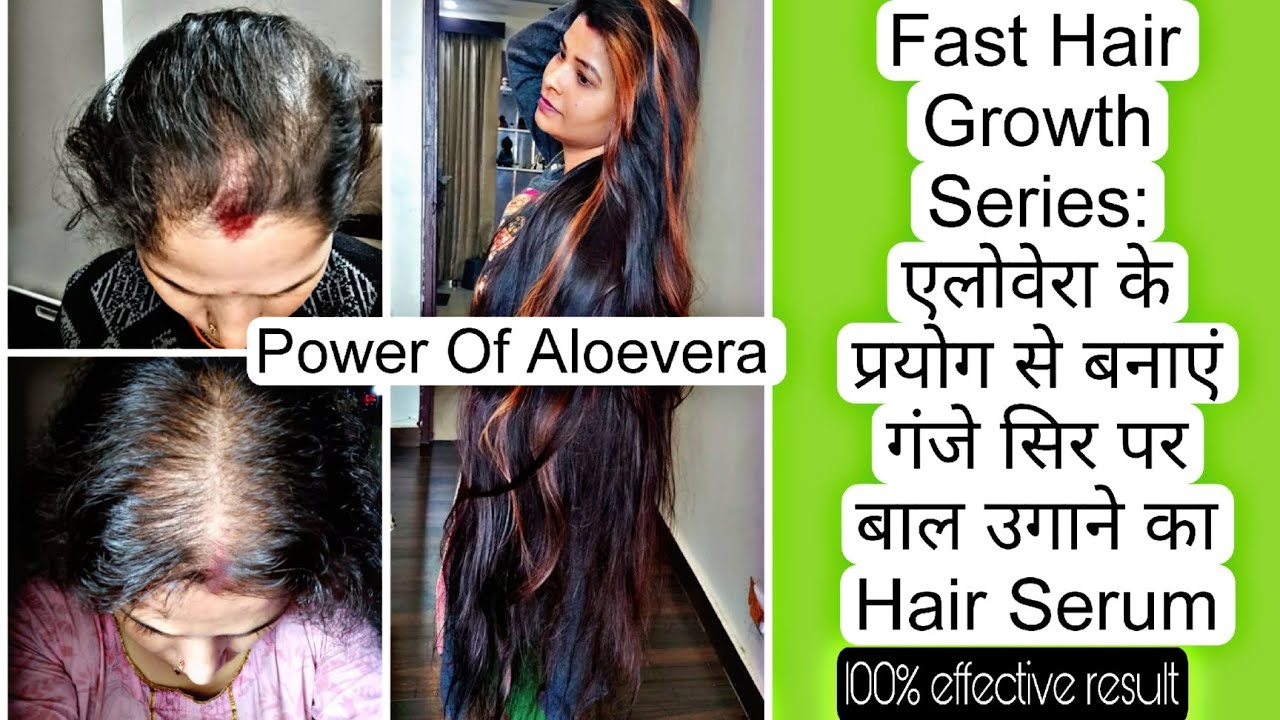 Fast Hair Growth Series: -पहली बार एलोवेरा का ऐसा प्रयोग जो गंजे सिर पर बाल उगाए भारी बनाएं बालों को