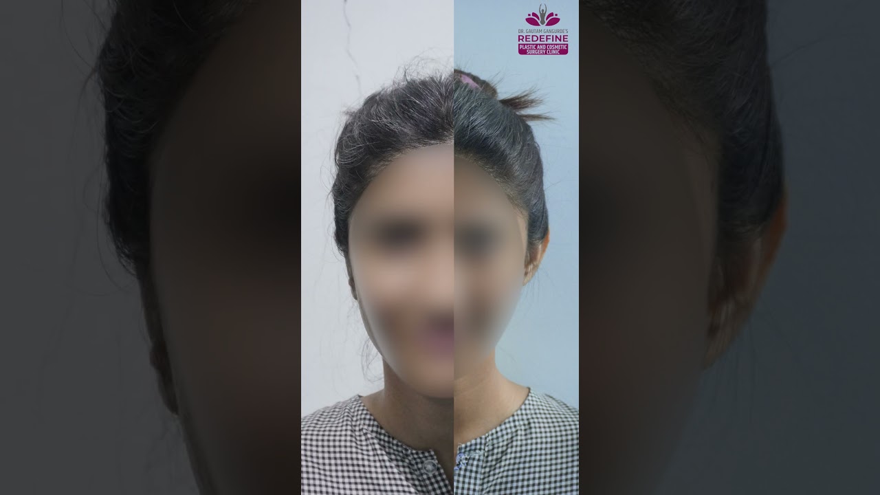 Bat Ear Surgery Result | Real Otoplasty Before & After Transformation