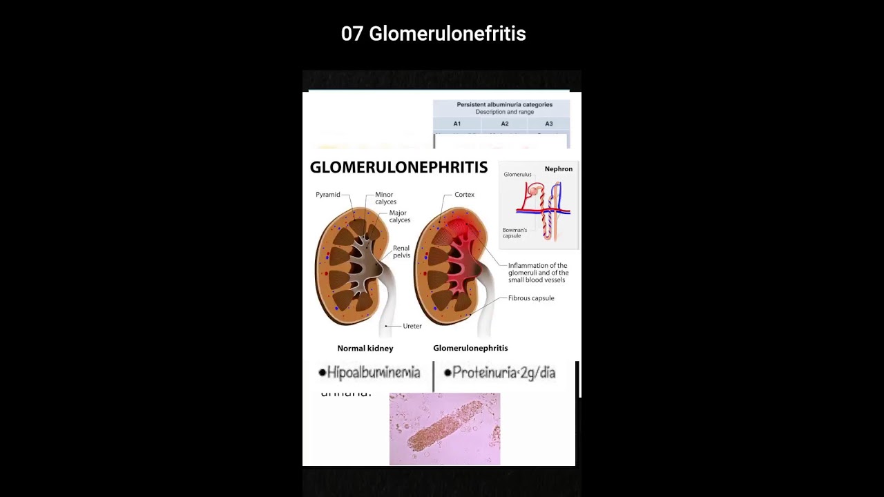 07 Glomerulonefritis