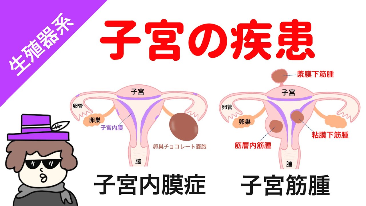 【試験対策】子宮疾患（子宮内膜症、子宮筋腫、子宮頸がん、子宮体がん）