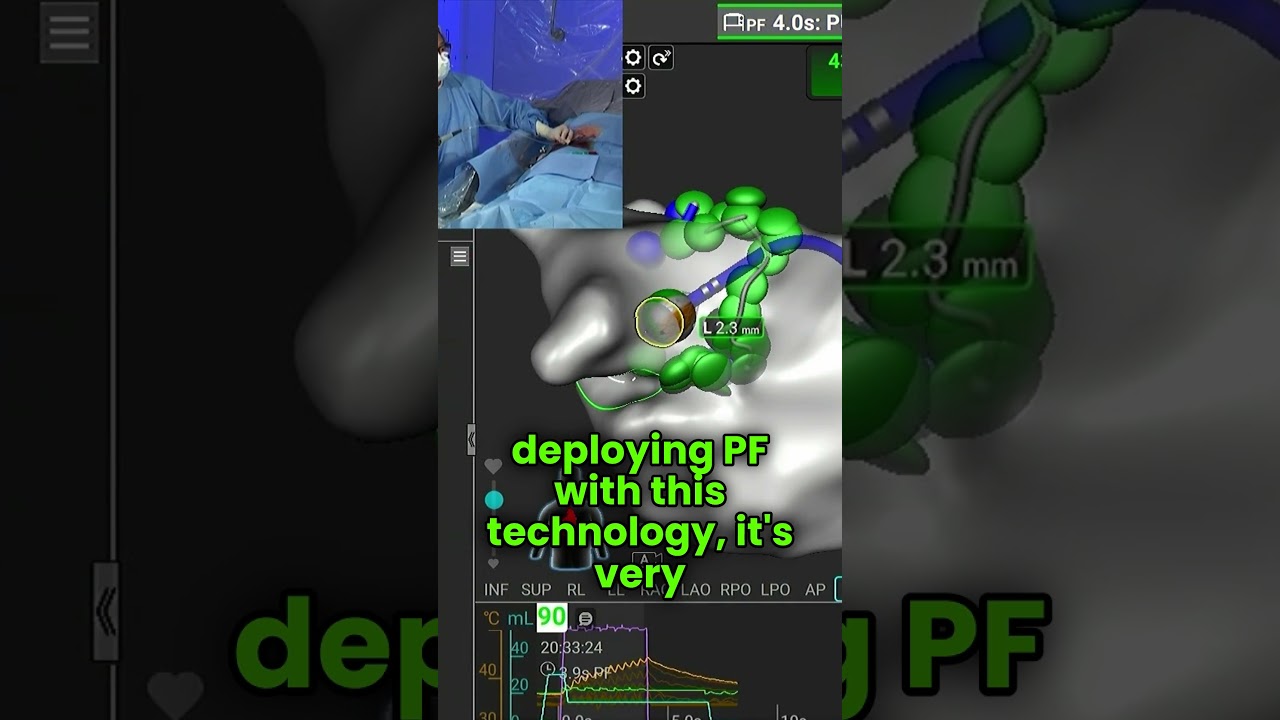 Affera Mapping and Ablation System with Sphere-9 Catheter