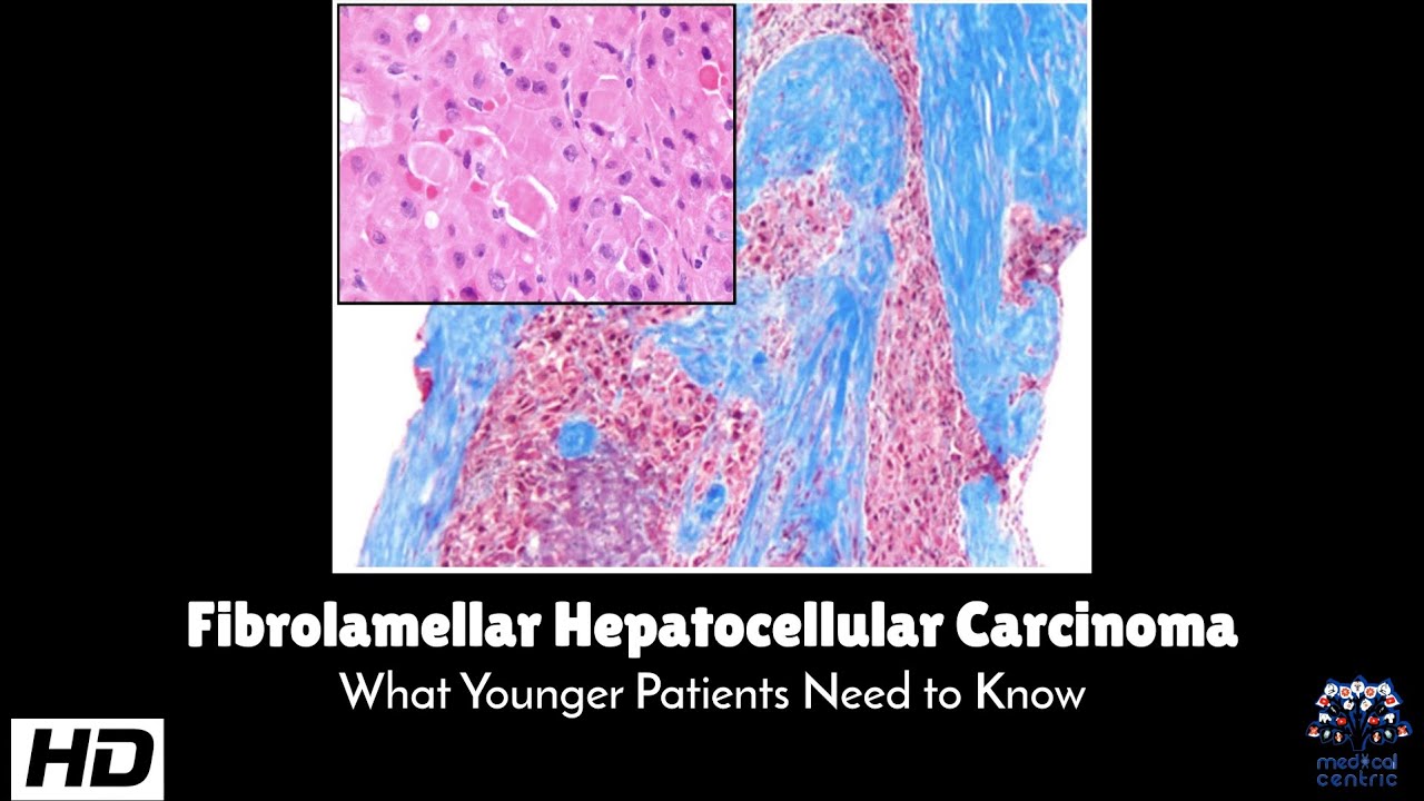 Fibrolamellar Hepatocellular Carcinoma : What Younger Patients Need to Know