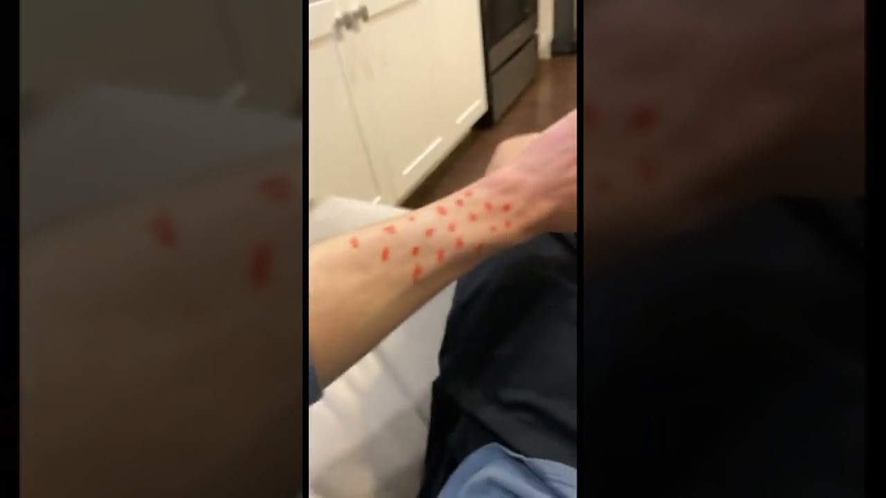 Chicken Pox #Shorts