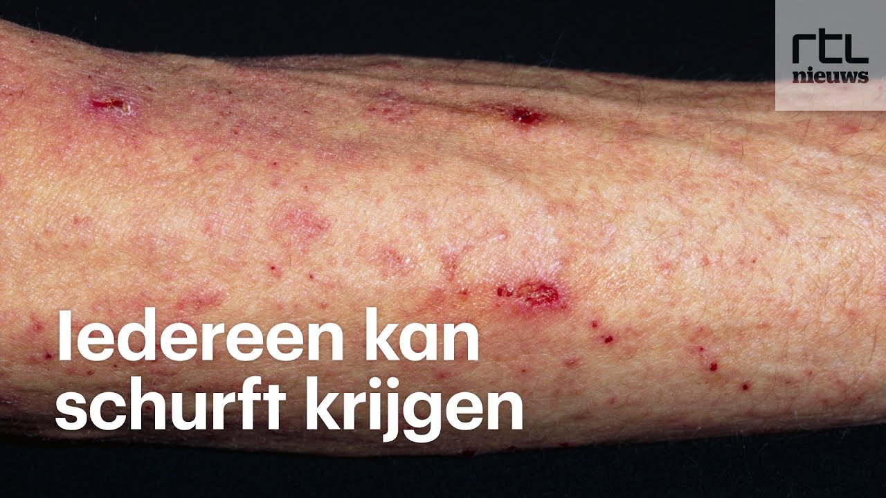 Vreselijke jeuk en erg besmettelijk: dit is schurft