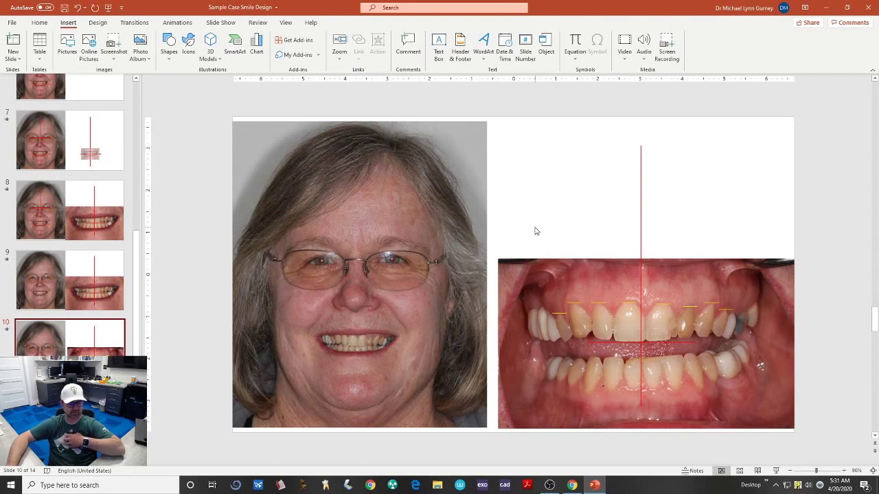 PowerPoint - Smile Design Part 3 - Completing the Smile Design