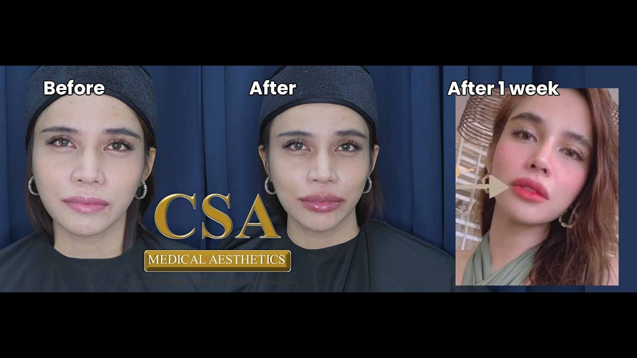 LIP LIFT: MODIFIED LIP FILLER INJECTION TECHNIQUE