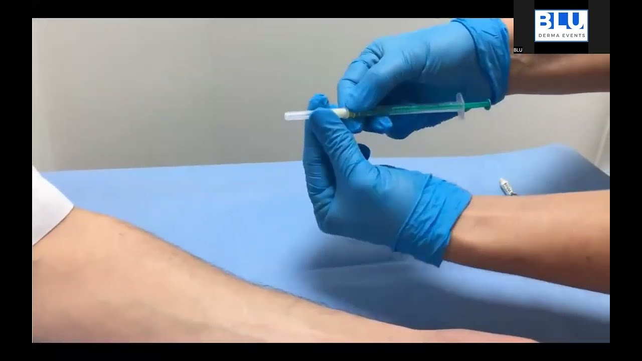 Hyaluronidase Allergy, Hyalase Allergy