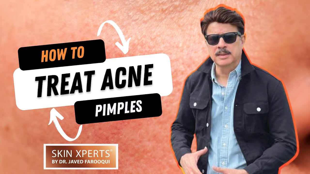 Get Rid Of Acne Forever | Acne - Pimple Permanent Treatment | Dr Javed Alam Acne Solution