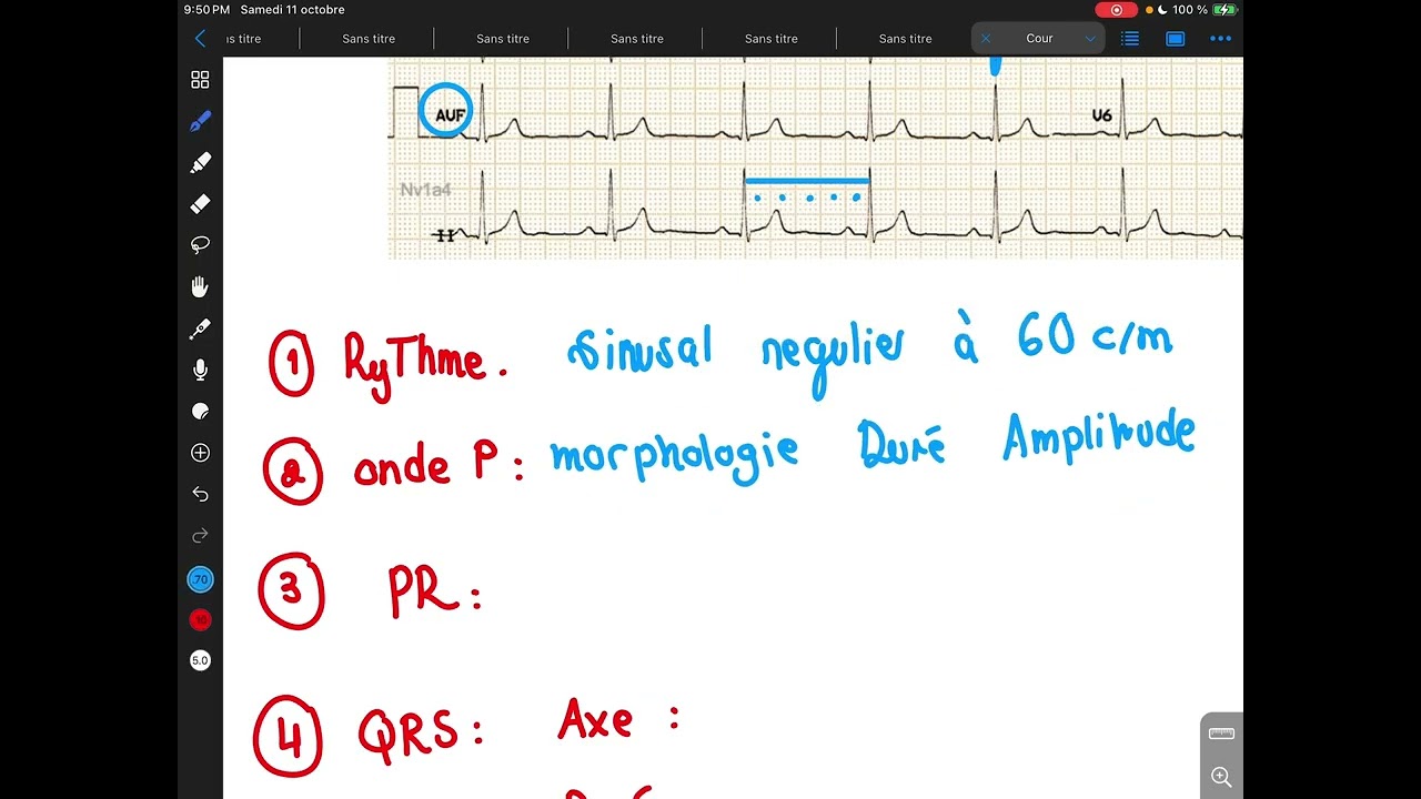  ECG normal interprétation 