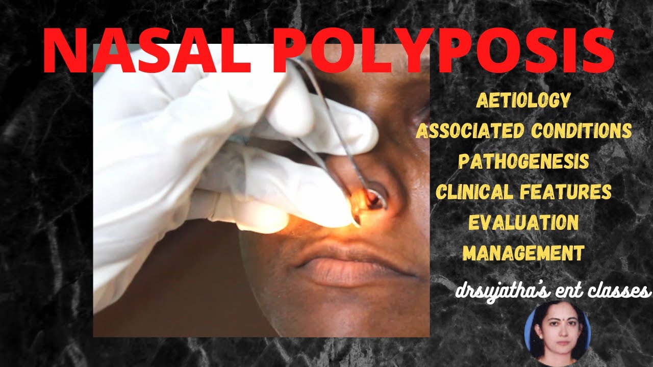 140.Nasal polyposis  