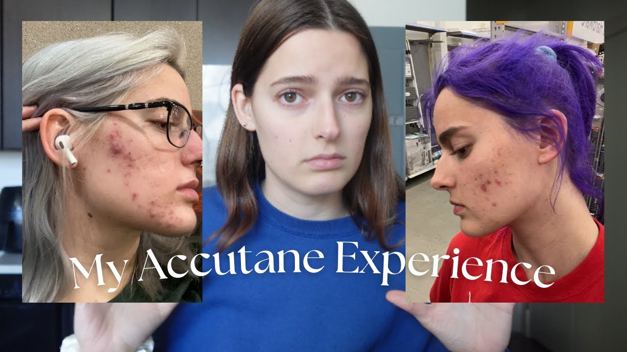 I took Accutane TWICE. My isotretinoin experience + before and after