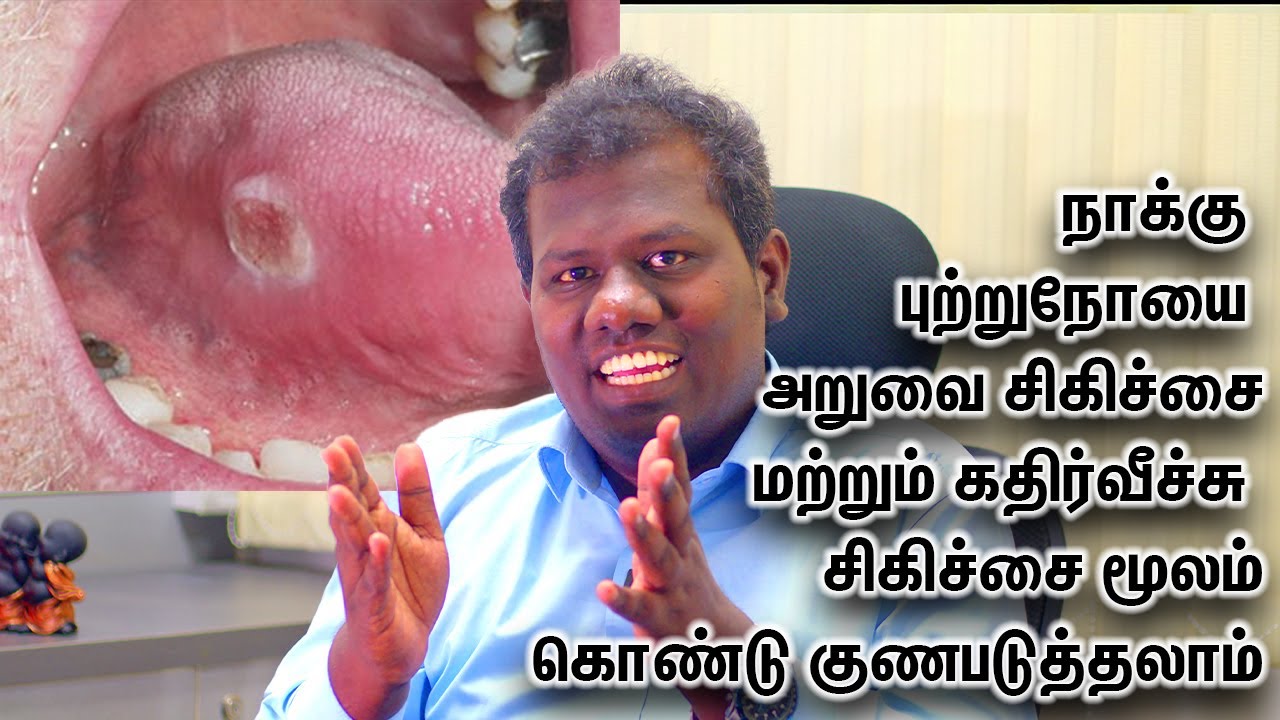 Stages & Treatment of Tongue Cancer Dr.Narendran