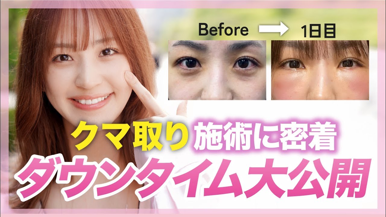 クマ取り密着！湘南クマ取りNo.1ドクターのカウンセリングからダウンタイム経過まで全て公開！