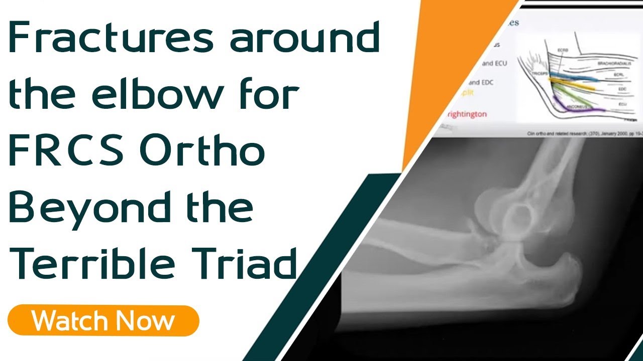 Fractures around the elbow for FRCS Ortho| Beyond the Terrible Triad | Orthopaedic Academy