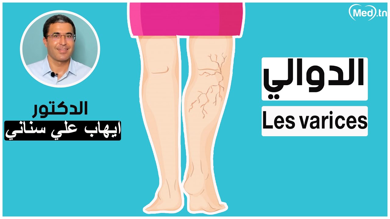 الدوالي  |  الدكتور ايهاب علي سناني