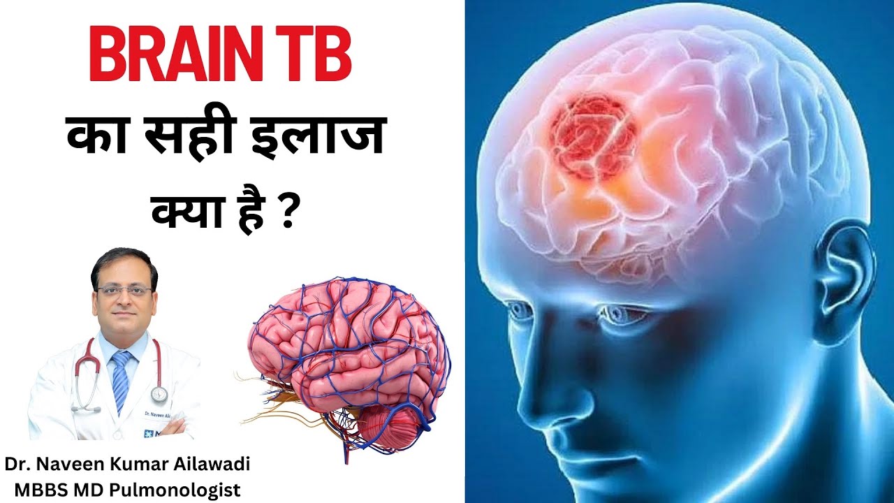 Brain Tuberculosis का सही इलाज क्या है ? | Brain TB Symptoms, Diagnosis and Treatment | 8368988131