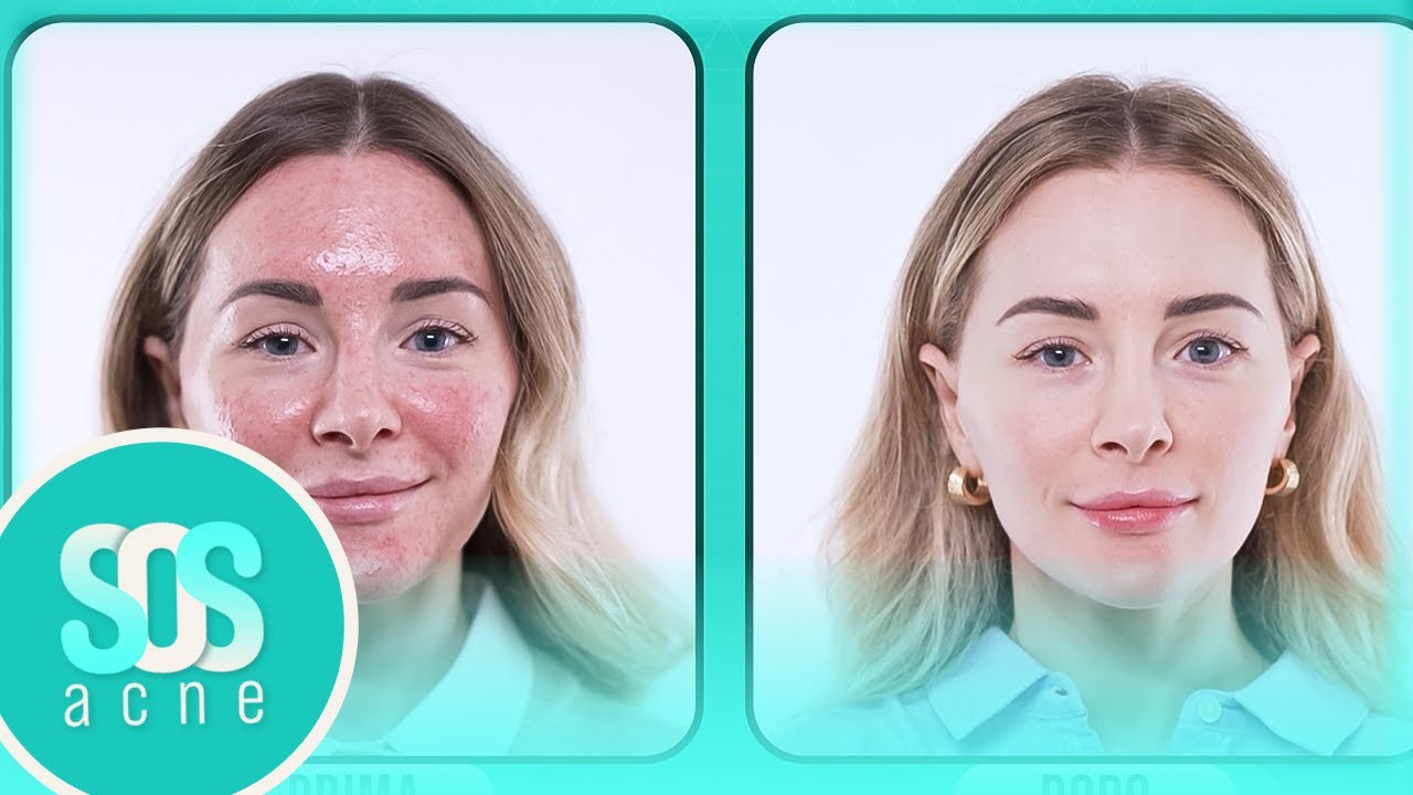 15 anni di acne rosacea: la trasformazione di Cecilia | Sos Acne