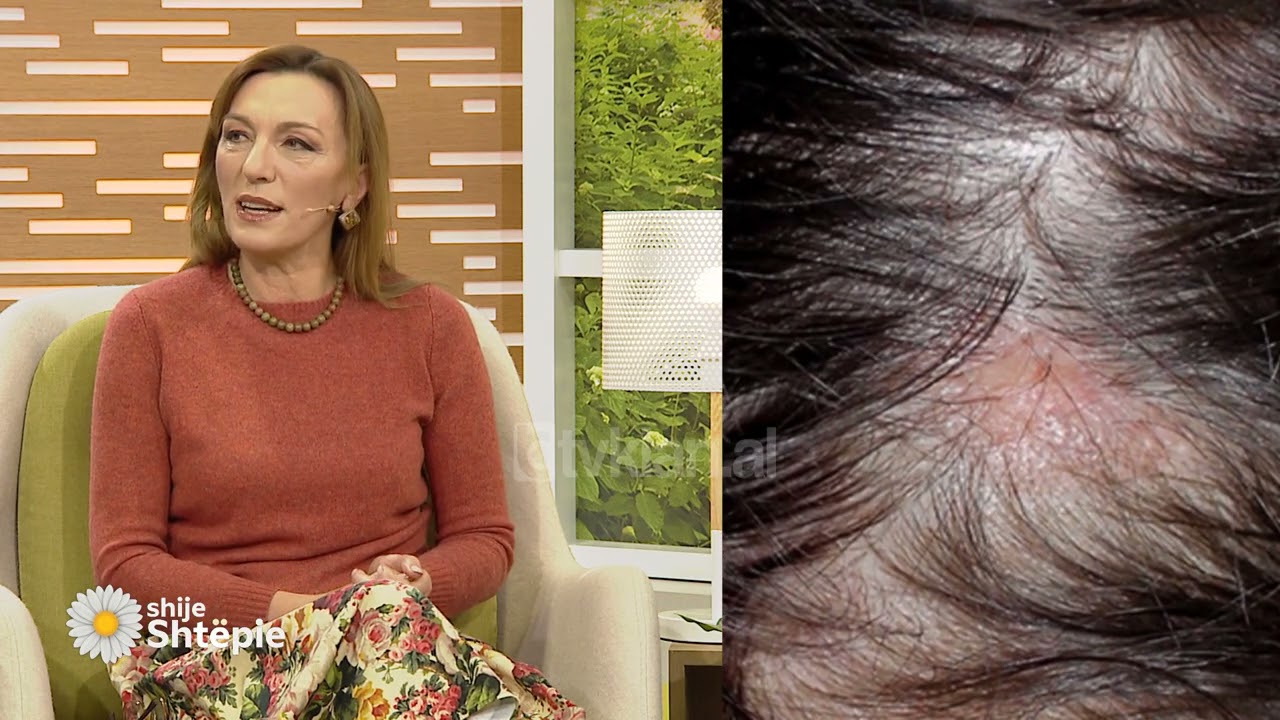 Dermatologia: Në rastin e mykut të flokëve, drejtohuni menjëherë te mjeku, është i rrezikshëm