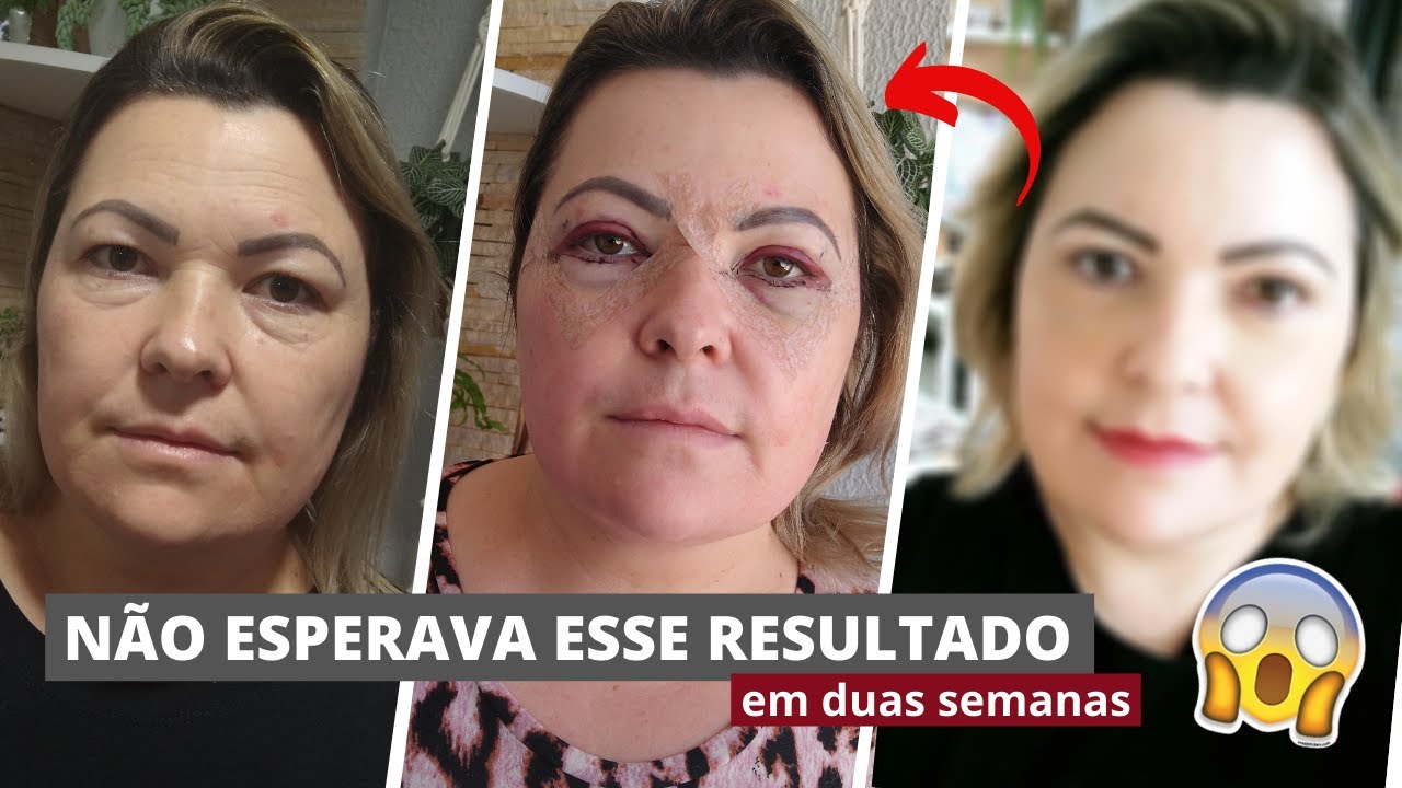 Minha primeira cirurgia plástica - Blefaroplastia