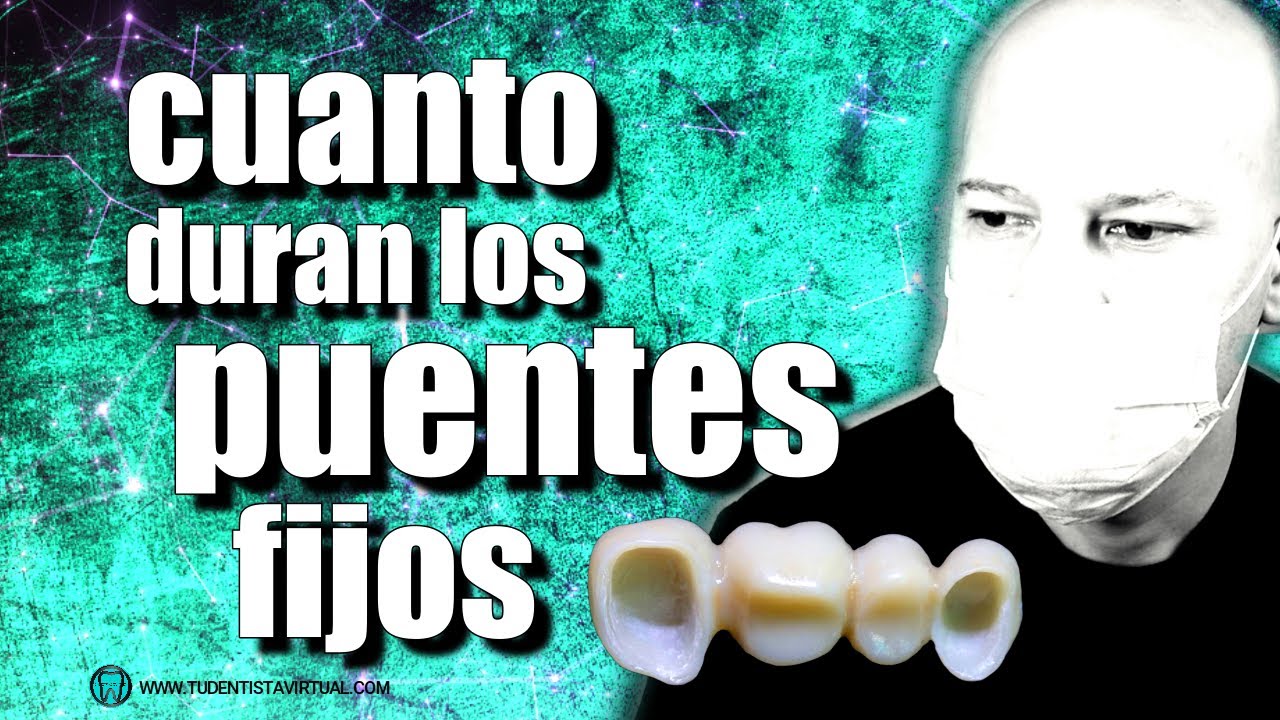 🔵PROBLEMAS con los PUENTES FIJOS sin IMPLANTES