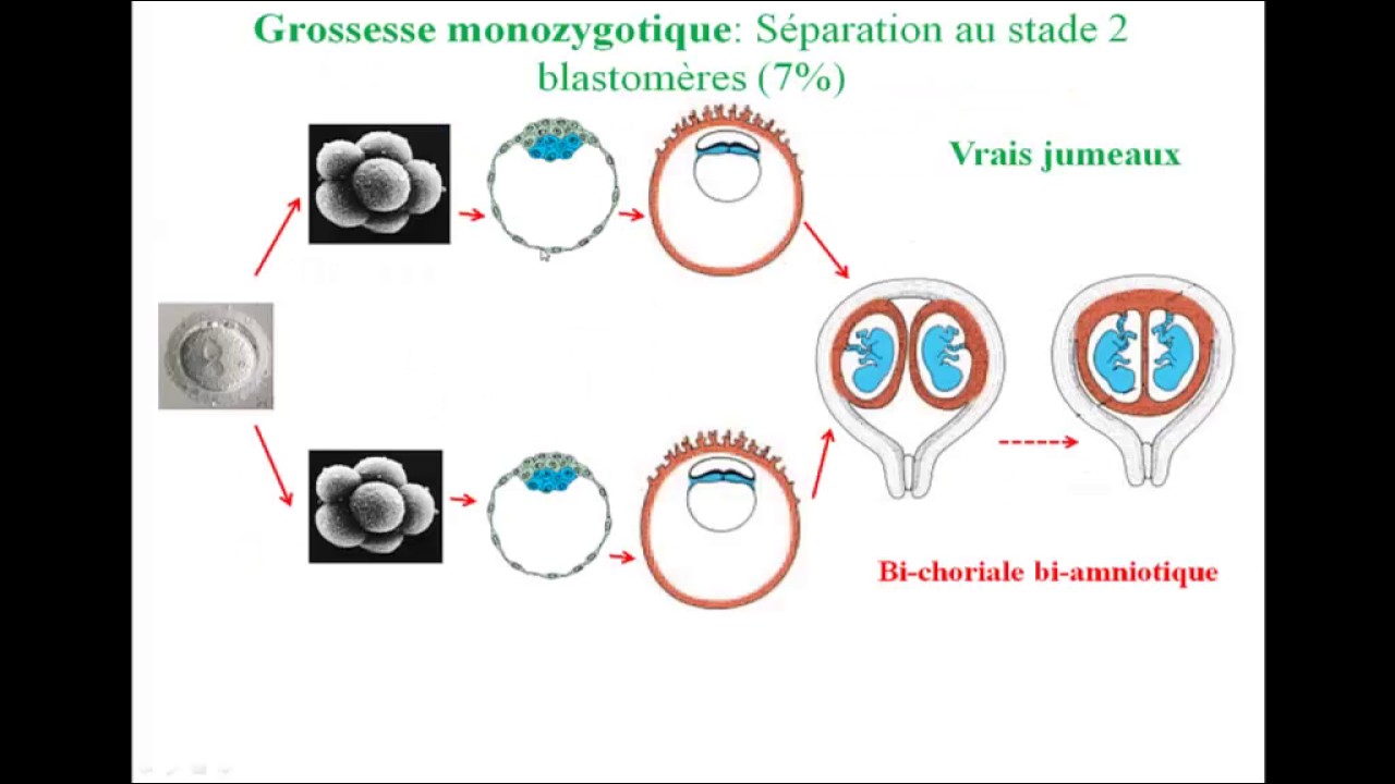 5- Grossesses gémellaires