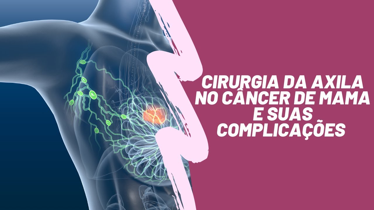 CIRURGIA DA AXILA NO CÂNCER DE MAMA E SUAS COMPLICAÇÕES