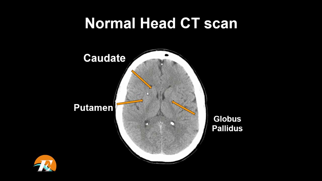 Normal Head CT Scan Anatomy Made Simple- Neuroradiology