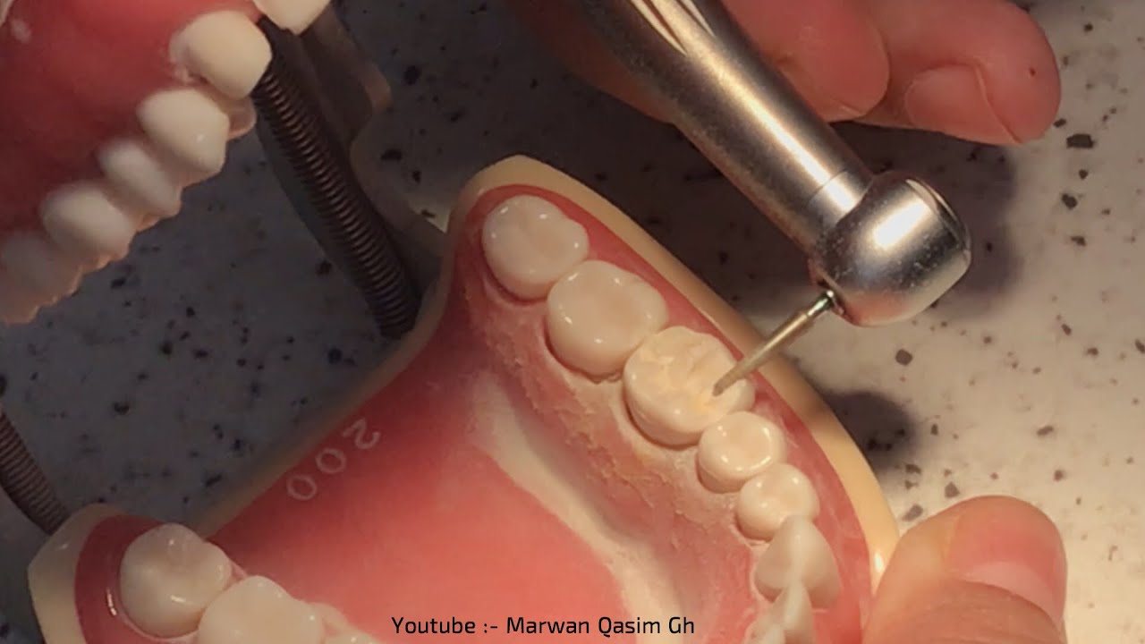 Posterior tooth (molar) preparation for crown ( dr.Suha )