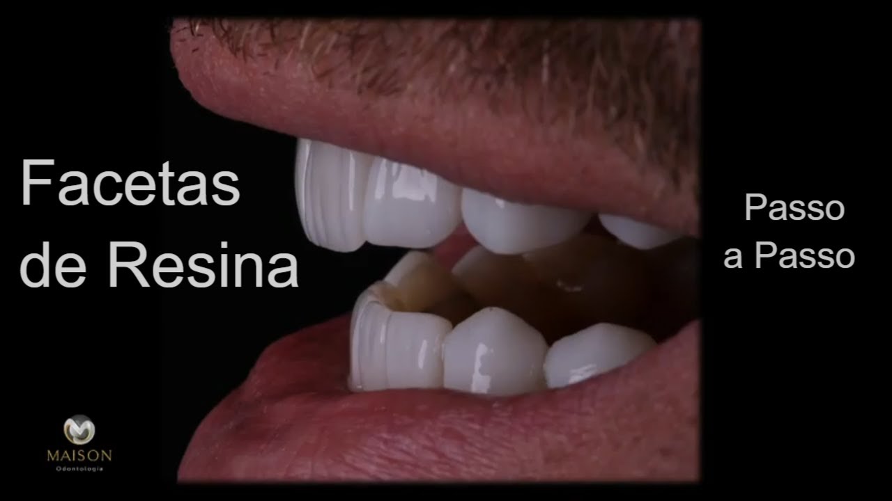 Faceta de Resina - Feita Passo a Passo