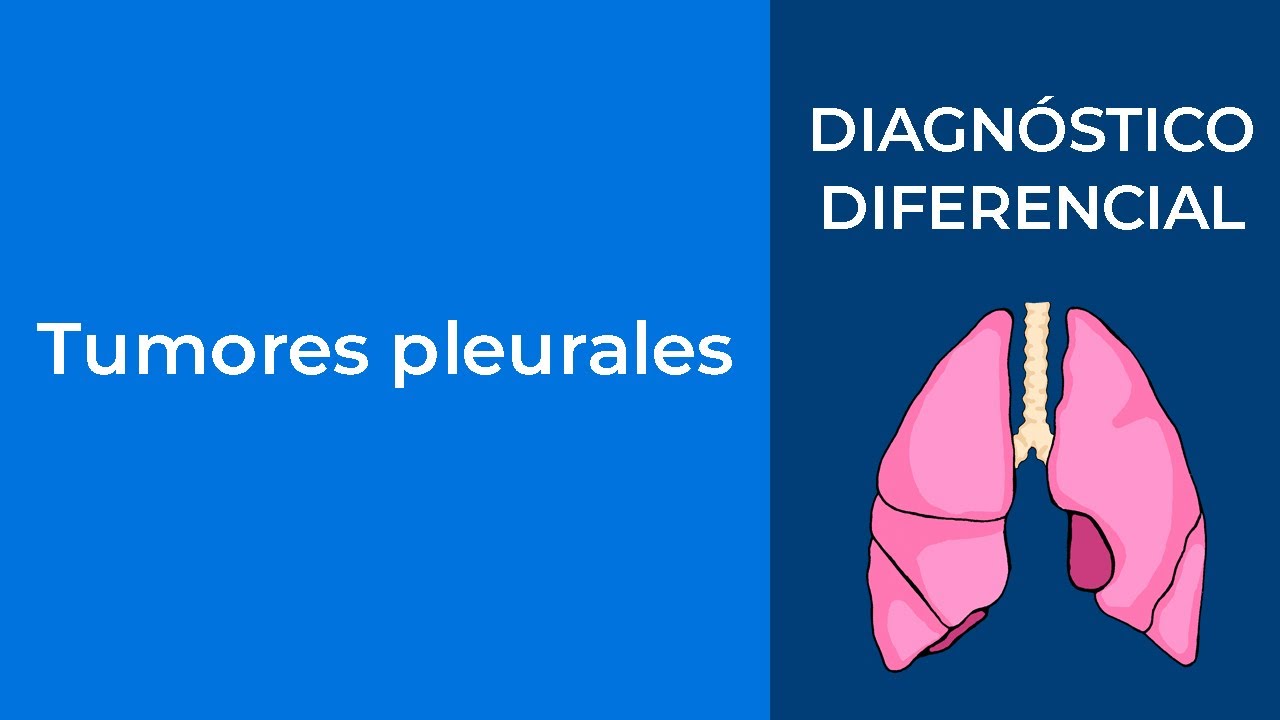 Diagnóstico Diferencial. Tumores pleurales