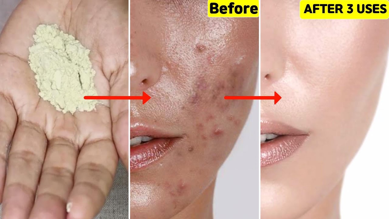 Facewash🙅🏻नहीं मैंने इसे आज़माया-Acne, Bumps, Oily skin, Pigmentation हुए 💯साफ़- चेहरा हुआ निखरा Clean