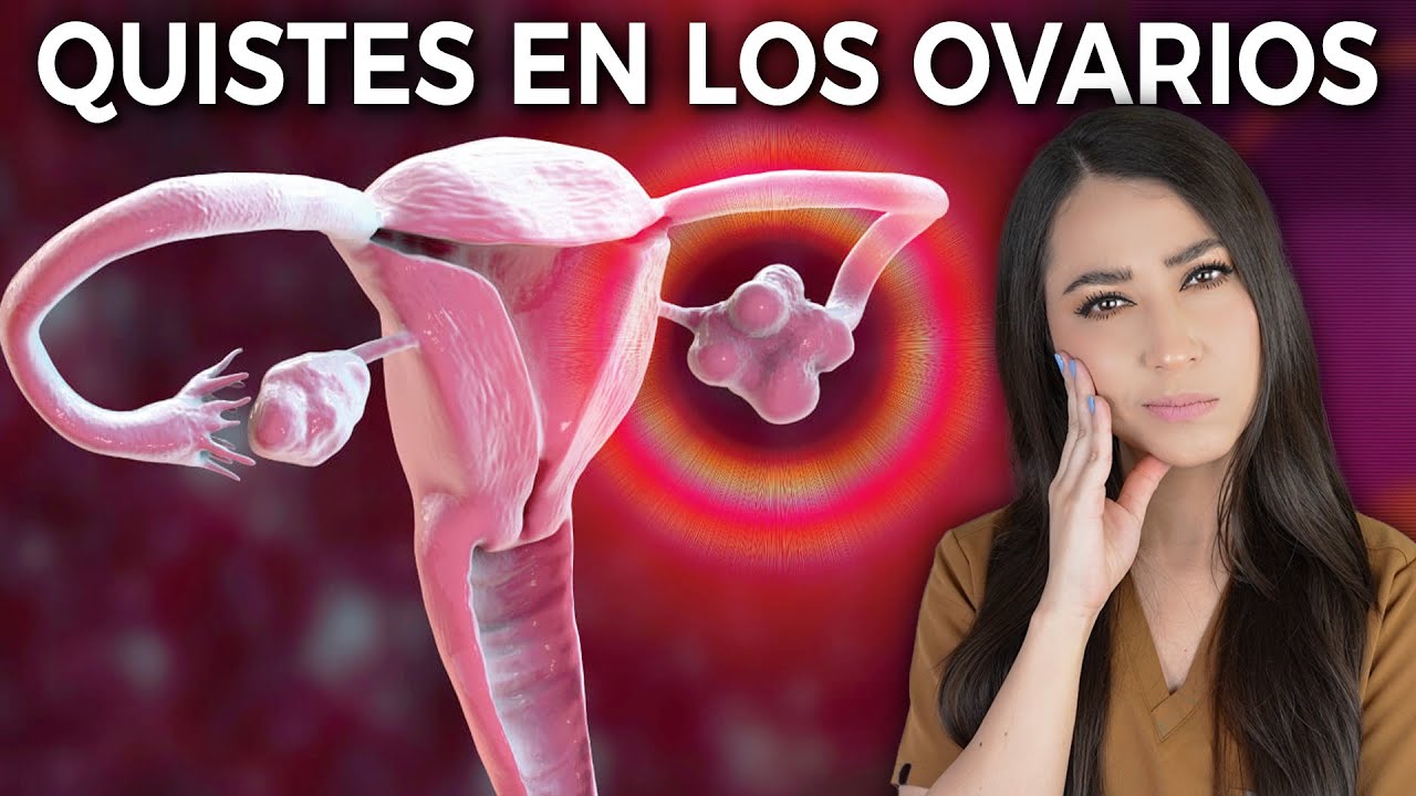SÍNDROME DE OVARIO POLIQUÍSTICO ¿Qué es y cómo tratarlo?👩🏻‍⚕️l  Dra. Pau Zúñiga