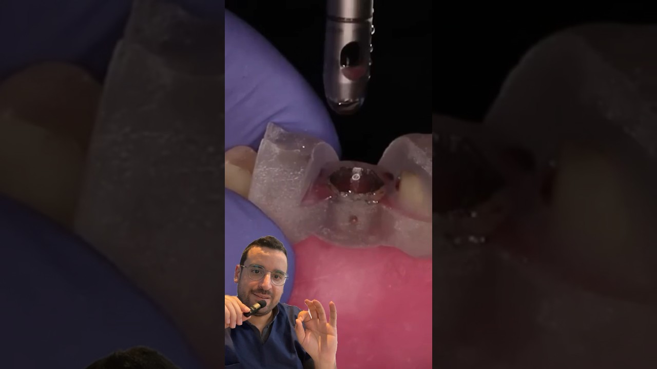 Pose d&rsquo;IMPLANT dentaire avec GUIDE implantaire