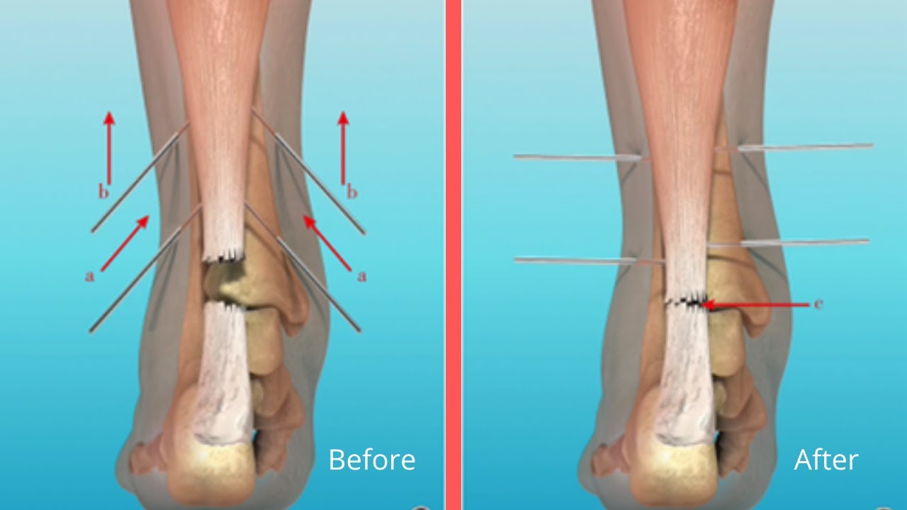 Successful Repair of Old Achilles Tendon Rupture in Ankle Joint | Dr. Muhammad Bilal Orthopedic