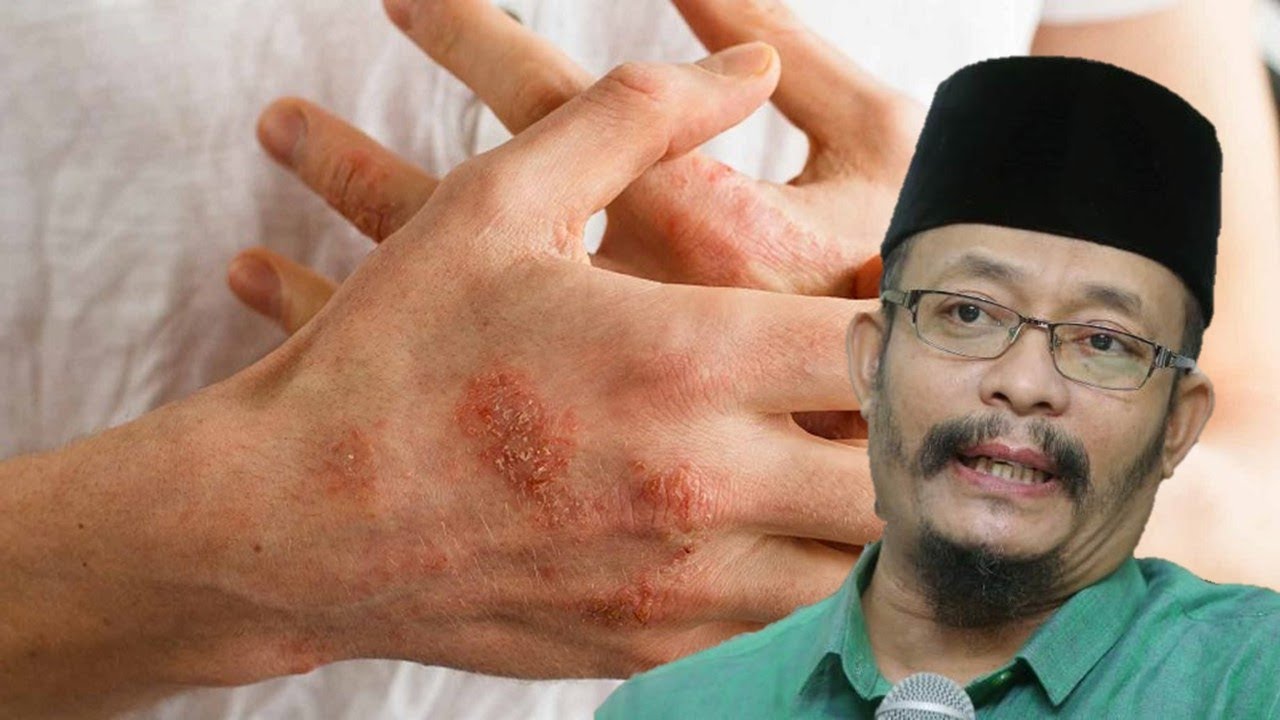Baca Doa Ini Kalau Ada Penyakit Kulit - Ustaz Kazim Elias