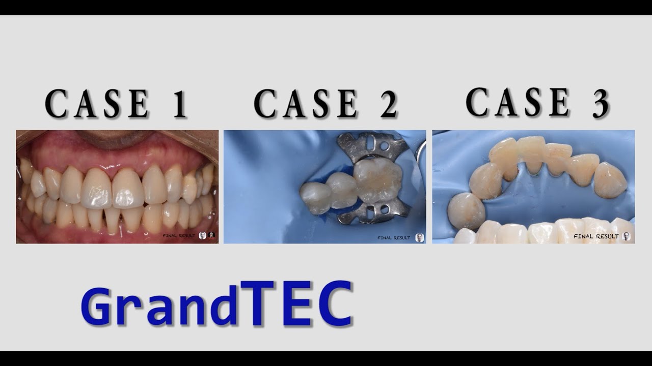 Intra & Extra Coronal Splinting in Periodontal Treatment❗ Glass Fiber Reinforced Composite, GrandTEC