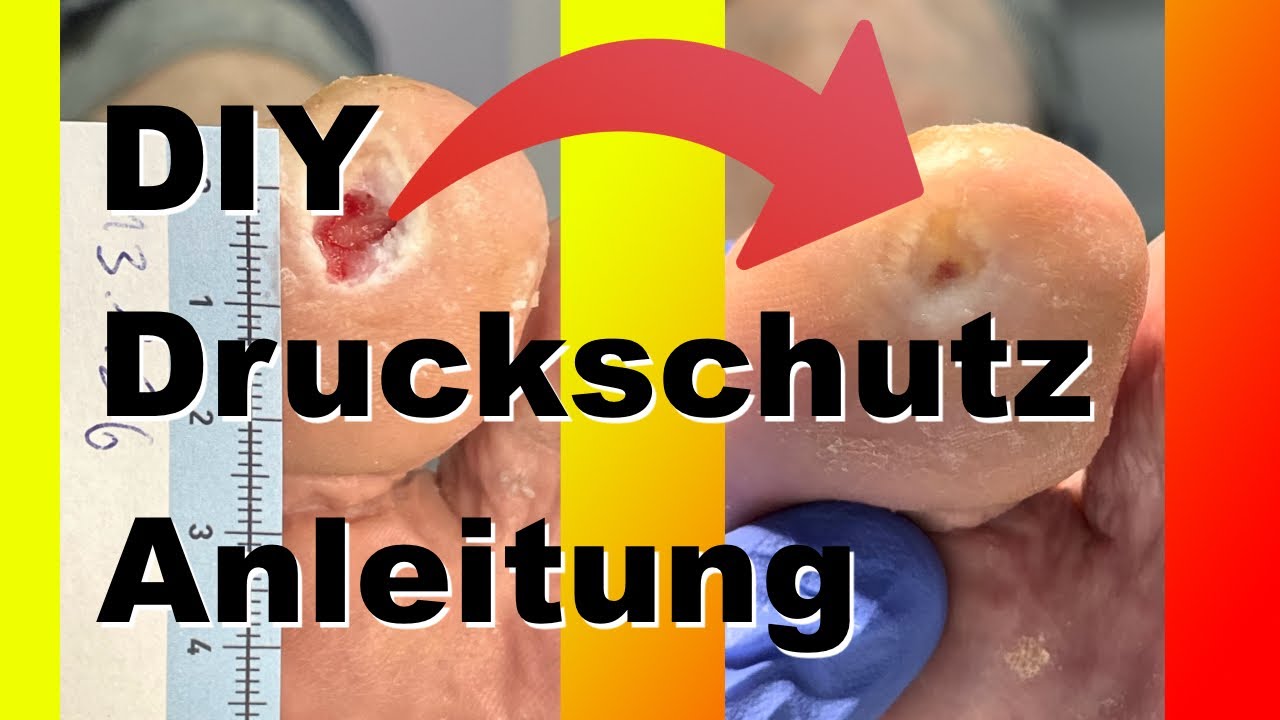 DIY Druckschutz f&uuml;r Wunde am Zeh Anleitung, Podologin Andrea