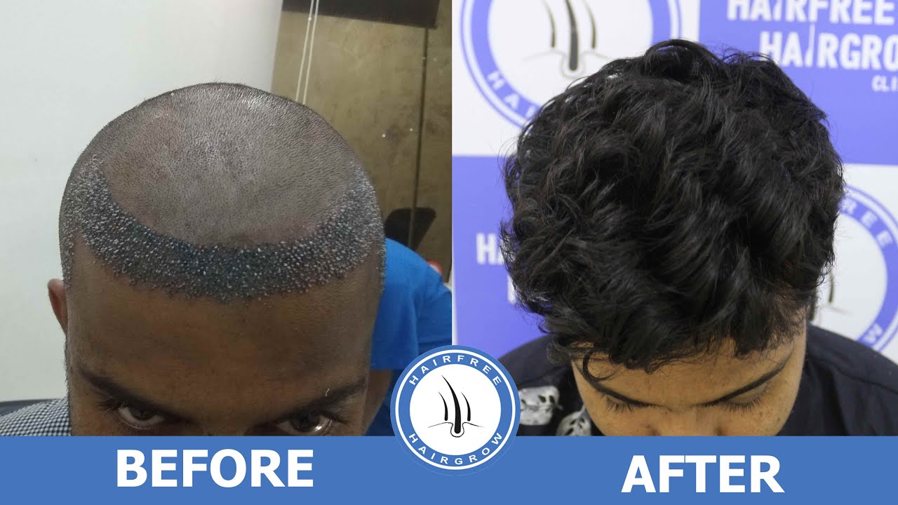 Best Hairline Temple Restoration in Hairfree & Hairgrow Clinic || Review by Patient After 1 Year...!
