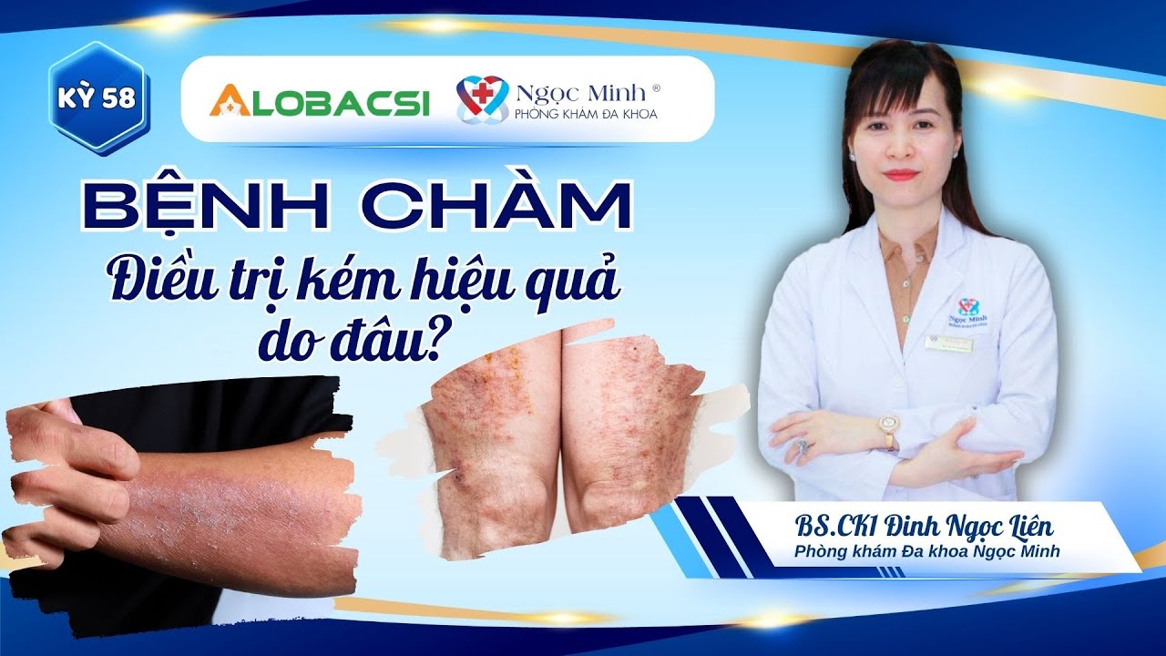 #58 Bệnh chàm (viêm da cơ địa), điều trị kém hiệu quả do đâu? | BS.CK1 Đinh Ngọc Liên