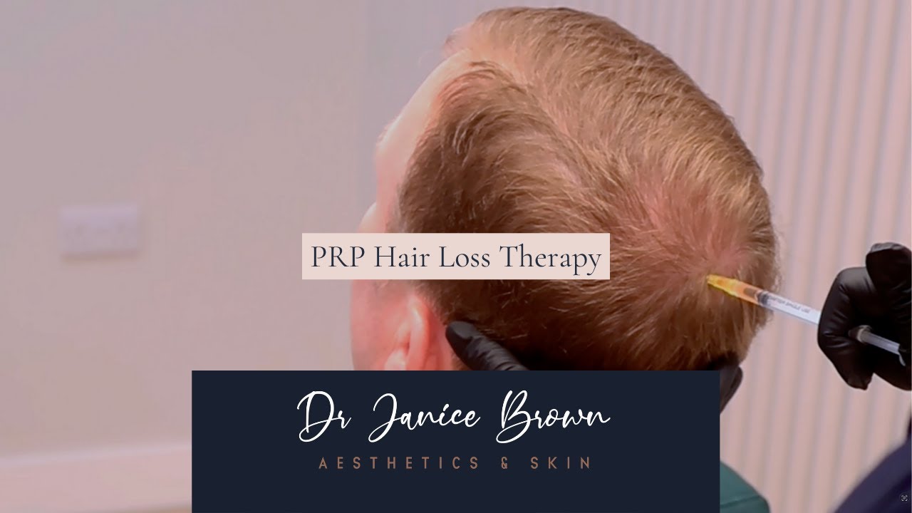 PRP Hair Loss Therapy