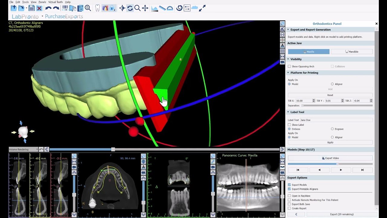 BSP V4.13: Design and Export Aligners for Direct Aligner Printing