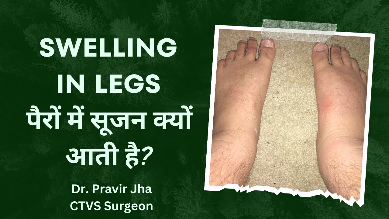 पैरों में सूजन - कारण और उपाय | Swelling in legs - Causes & Solution | Dr. Pravir Jha