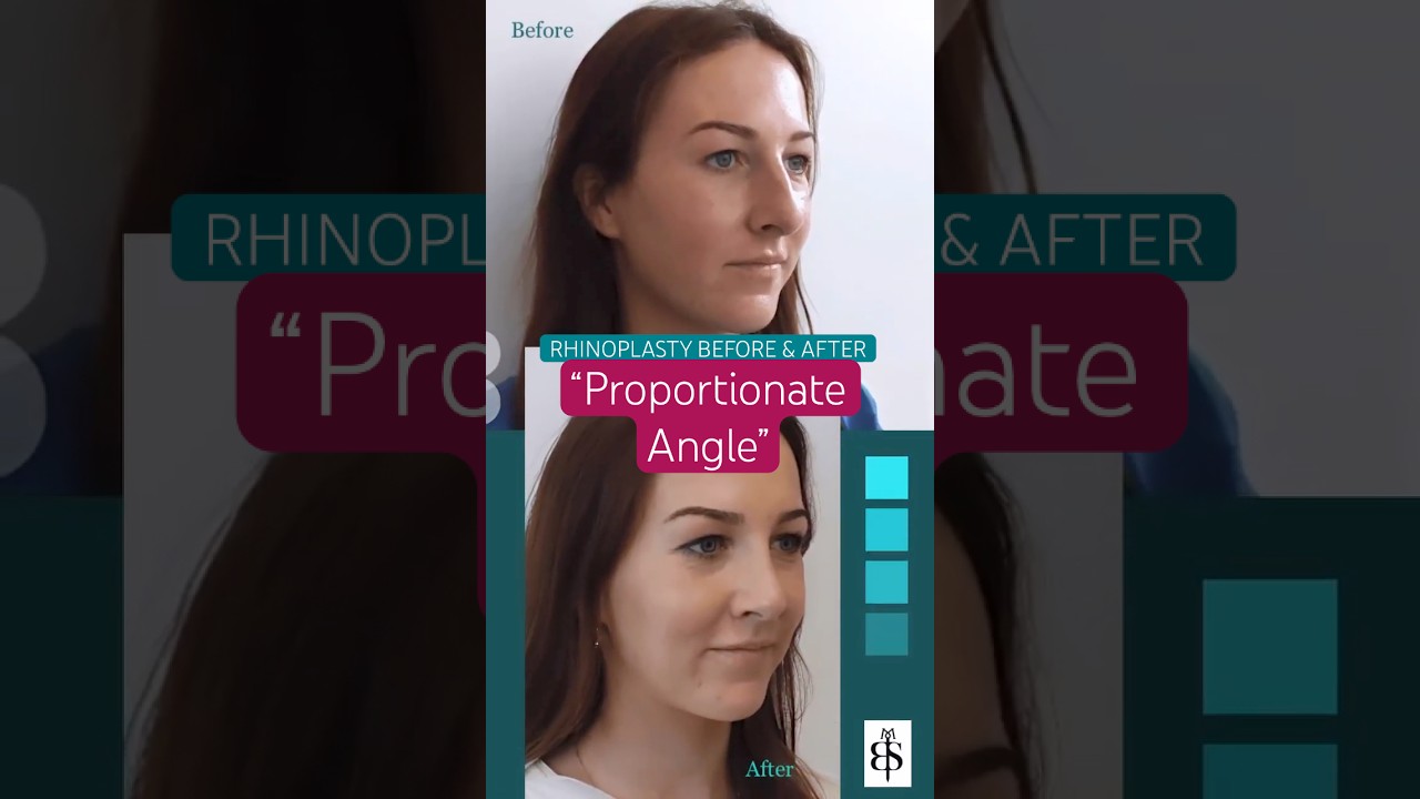Best Rhinoplasty Surgeon UK | 19-Year-Old Nose Job Before & After by Mr. Taimur Shoaib