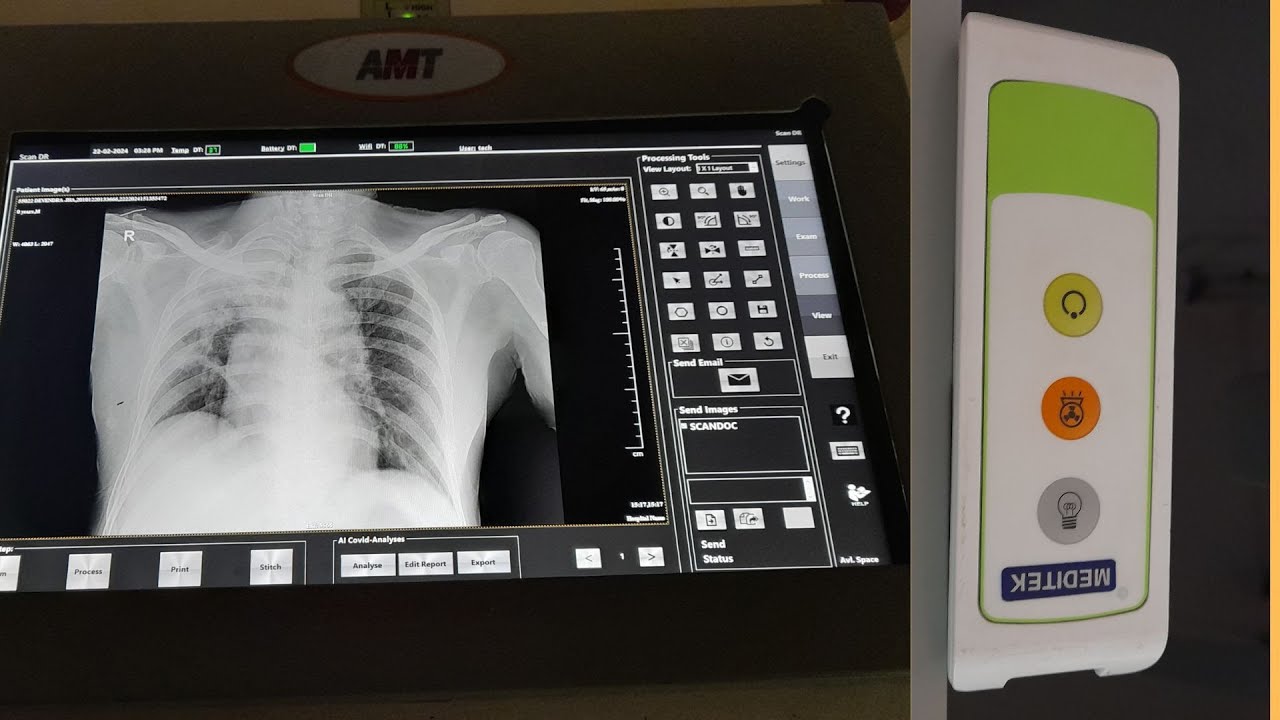 ডিজিটাল এক্স রে মেশিন  digital portable x ray matching