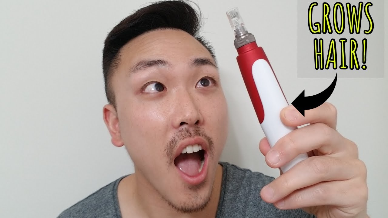 PROOF MICRONEEDLING (BY ITSELF) WORKS FOR HAIR LOSS!