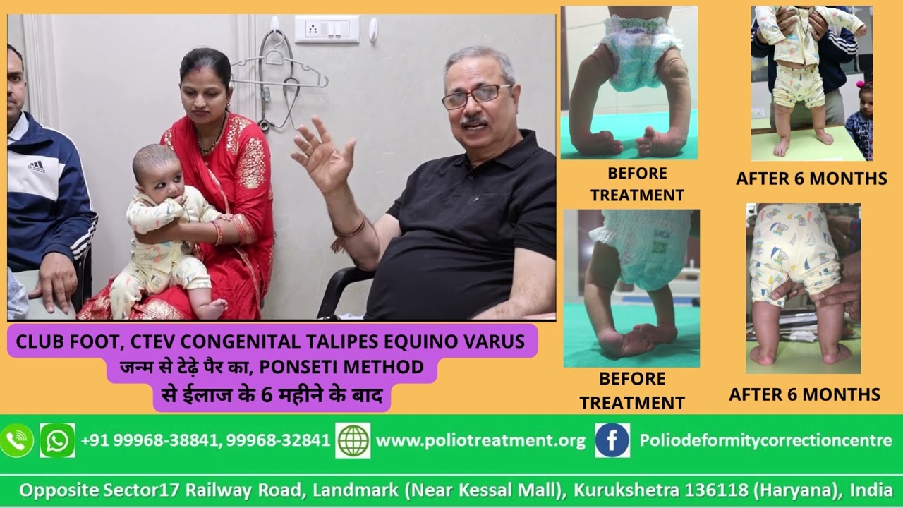 CLUB FOOT, CTEV , जन्म से टेढ़े पैर का, PONSETI METHOD से ईलाज के 6 महीने के बाद Bhola Hospital