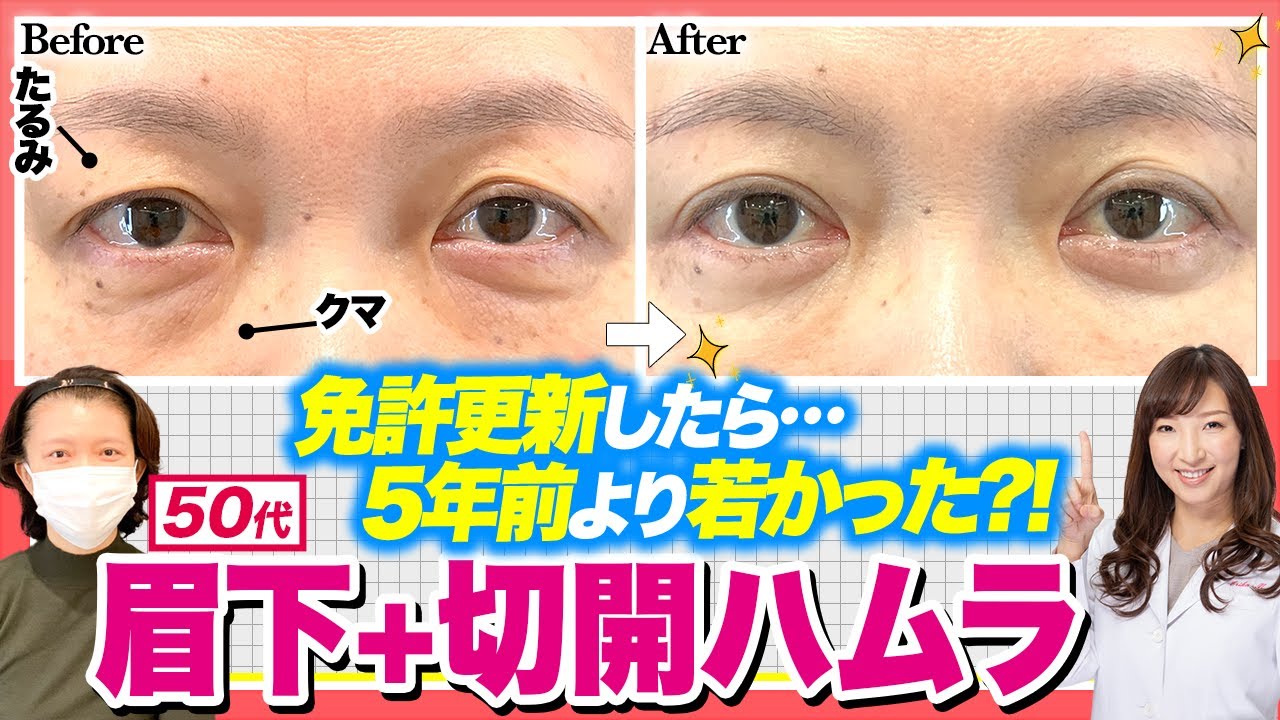 目元上下手術で10歳若返り？！【眉下リフト＋切開ハムラ】